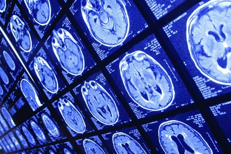 AI algorithm detects and identifies brain lesions